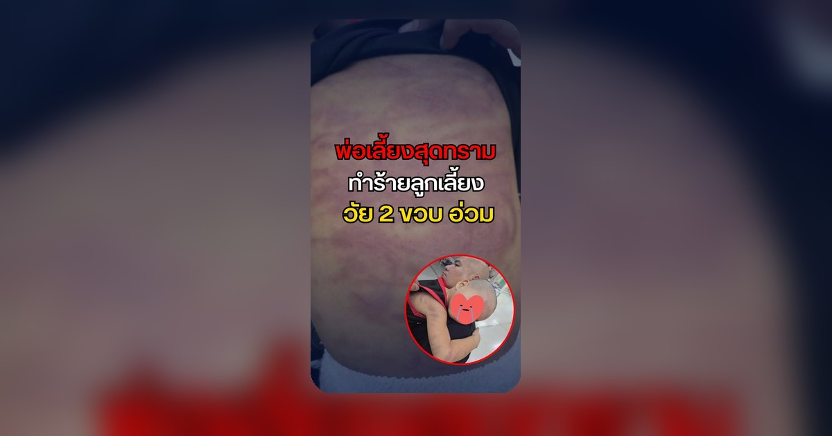 สะเทือนใจ! พ่อเลี้ยงโหดซ้อมเด็ก 2 ขวบไม่ยั้ง แม่อุ้มลูกหนีตัดขาดเด็ดขาด