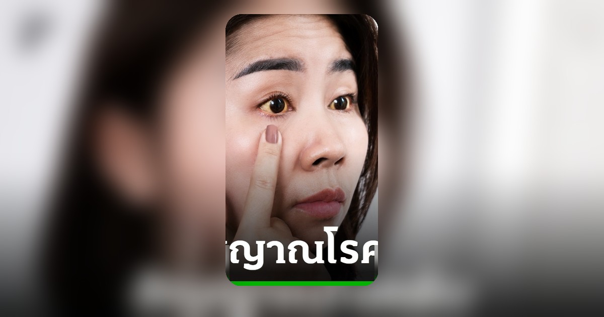 สังเกต 7 สัญญาณโรคตับ ตาเหลือง-อาการคัน ภัยเงียบที่ไม่ควรมองข้าม