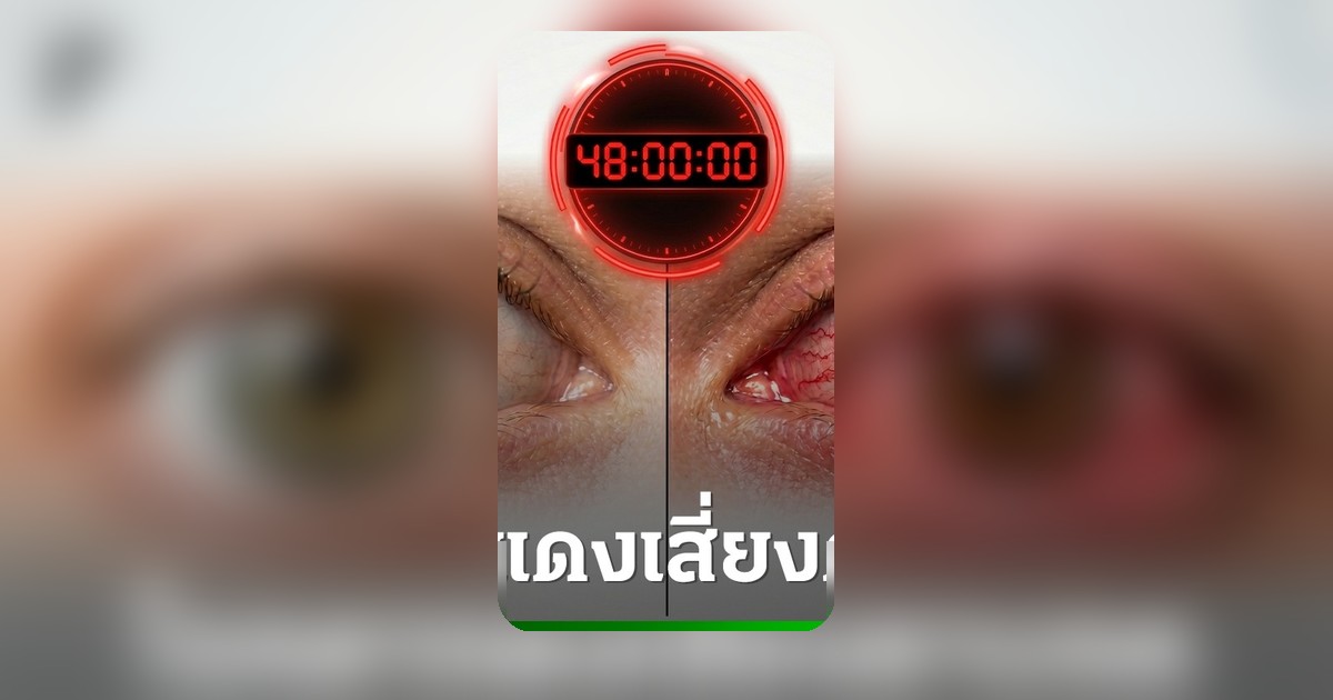 อาการตาแดงช่วงฤดูฝน เช็กด่วน 3 พฤติกรรมเสี่ยง อาจทำให้ตาบอดถาวรได้