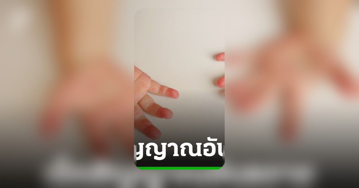 โรคมือเท้าปากระบาดช่วงเปิดเทอม เช็กสัญญาณอันตราย ล้างมือด้วยสบู่สำคัญกว่าเจลฆ่าเชื้อ